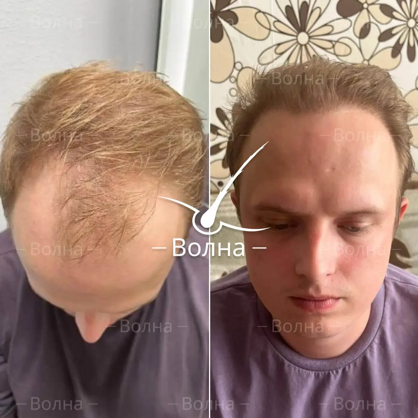 Результаты пересадки волос