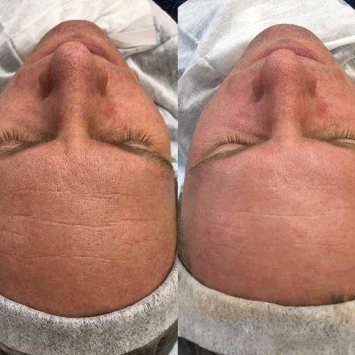 Косметологическая чистка лица или спины