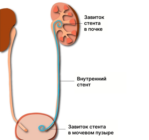 Стенки мочеточника