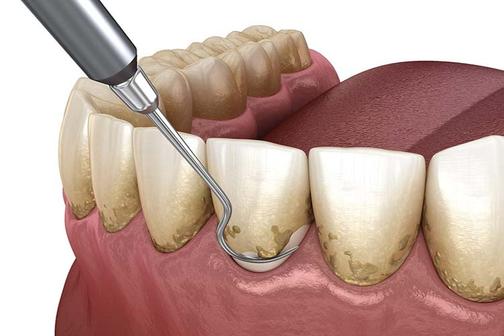 Как удалить зубной камень в домашних условиях?
