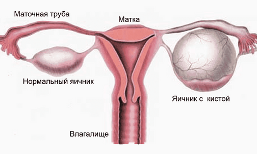 Боли после лапароскопии