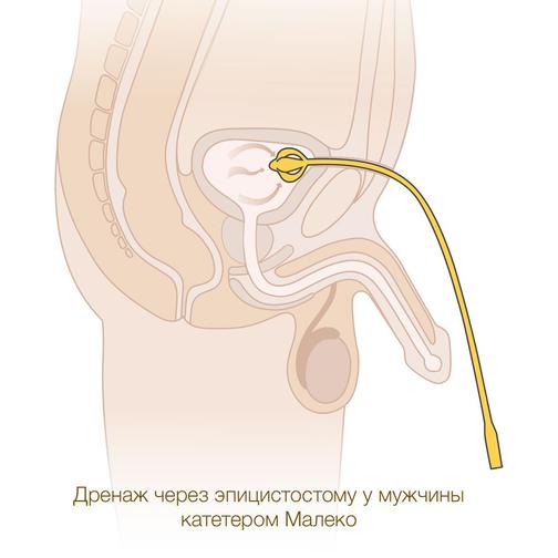 Катетеры Малеко