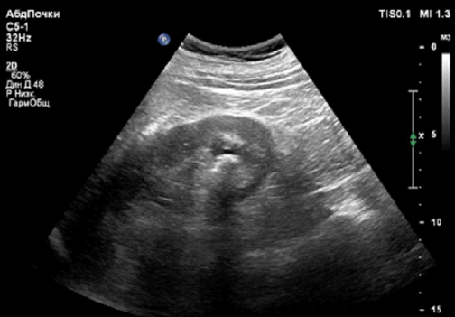 Диагностика мочекаменной болезни