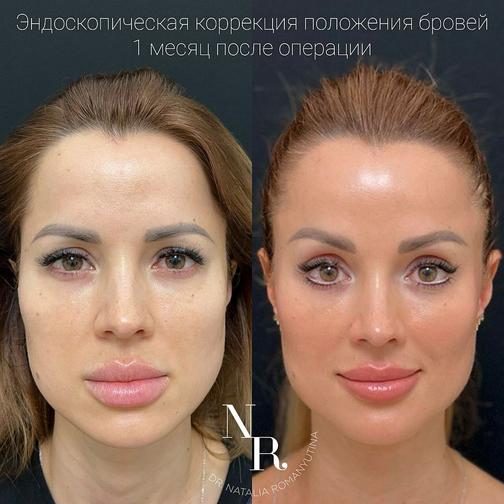 Галерея работ. Эндоскопический лифтинг лба, бровей