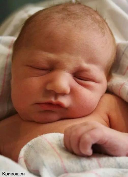 Лечение кривошея у ребенка