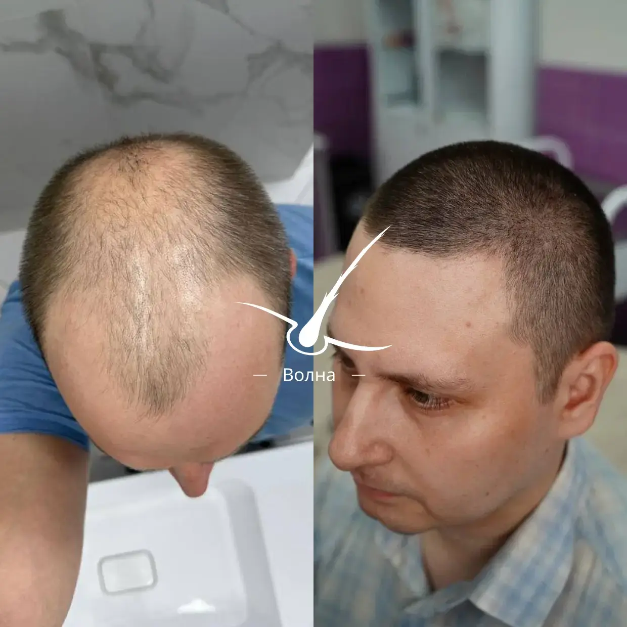 Результаты пересадки волос