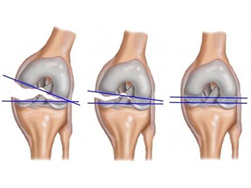 Восстановление после разрыва менисков коленного сустава