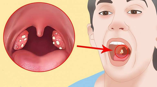 Гнойная ангина: симптомы у взрослых и детей, способы лечения заболевания