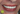 Cerec 3D до и после_17