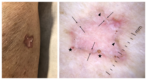 Порокератоз: дерматоскопические признаки