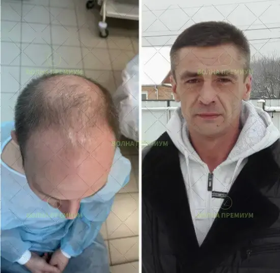 Результаты пересадки волос