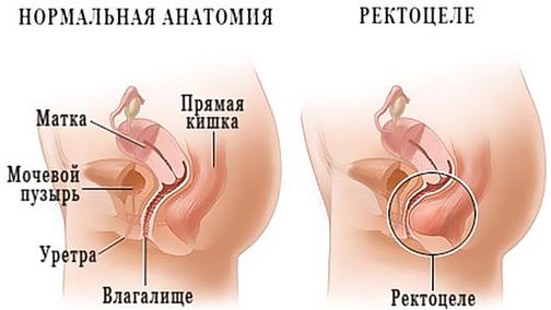 Атрезия девственной плевы: причины, симптомы и лечение