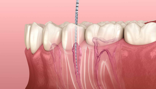 Как проводится лечение корневых каналов зуба?