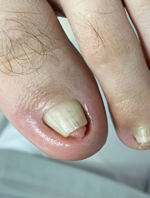 Признаки онихолизиса ногтей
