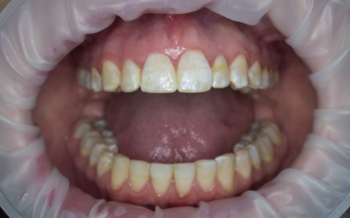 Лечение зубов фтором - Статьи