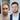Результаты пересадки волос