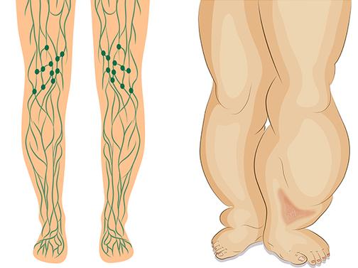 Что такое лимфостаз и как его лечат?: статьи клиники Оксфорд Медикал Киев