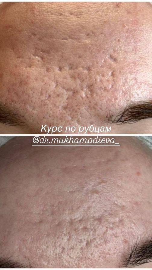 antiacne.pro