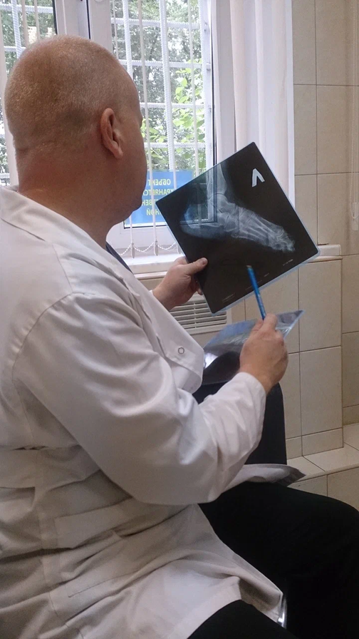 Псориатический артрит - причины, осложнения, лечение